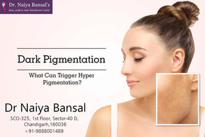 Dr Naiya Bansal - Pigmentation Treatment in Chandigarh