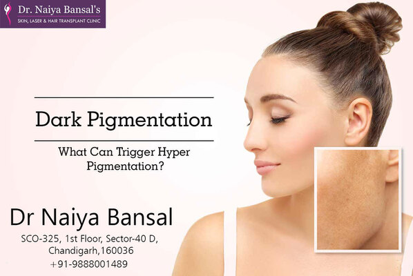 Dr Naiya Bansal - Pigmentation Treatment in Chandigarh